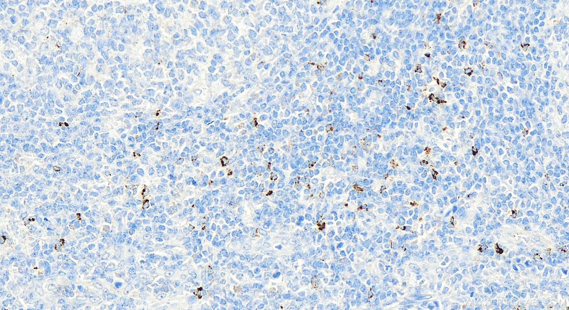 IHC staining of human tonsillitis using 16616-1-AP