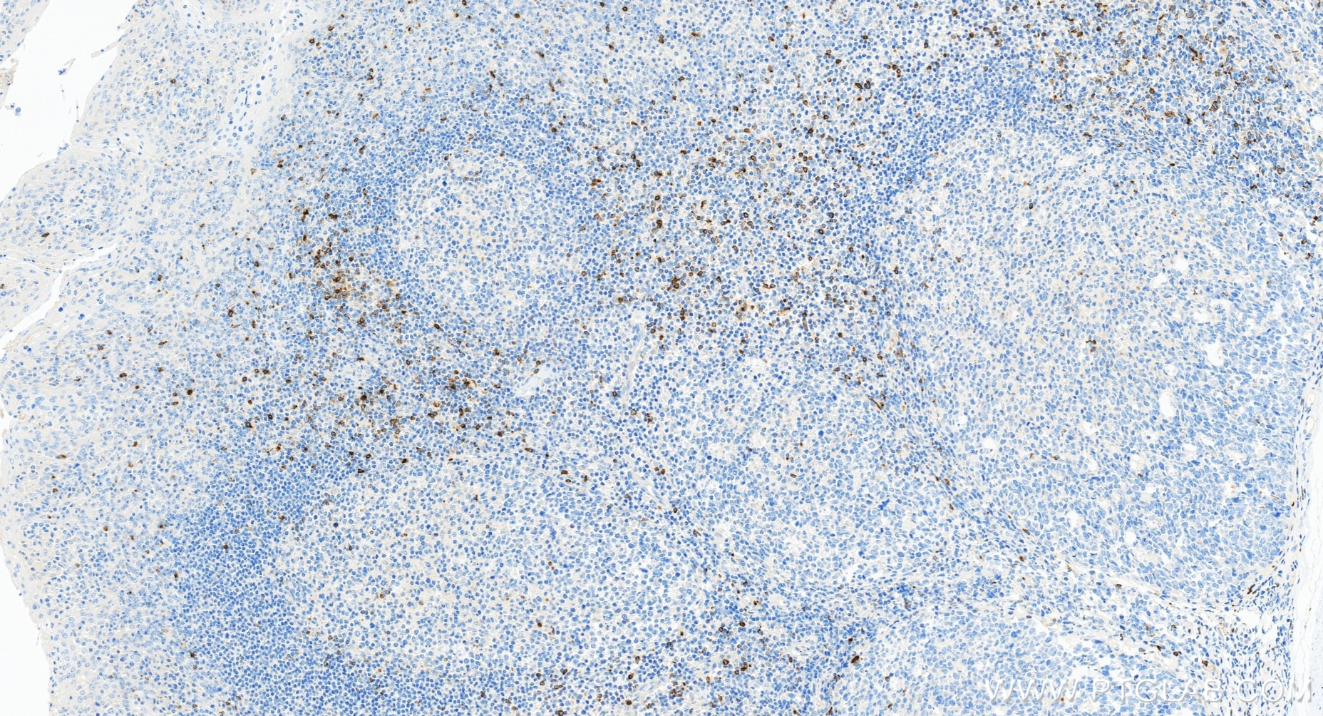 IHC staining of human tonsillitis using 98435-3-RR (same clone as 98435-3-PBS) IHC staining of human tonsillitis using 98435-3-RR (same clone as 98435-3-PBS)