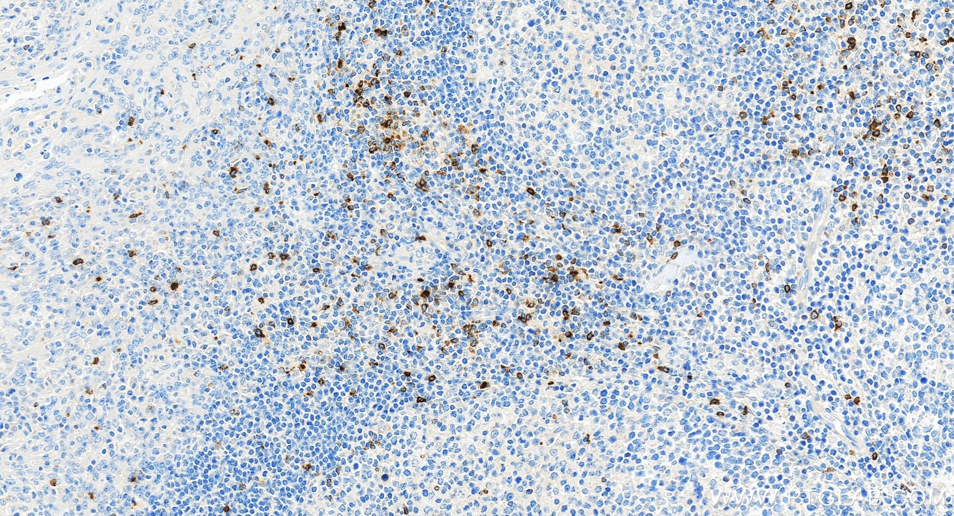 IHC staining of human tonsillitis using 98435-3-RR (same clone as 98435-3-PBS) IHC staining of human tonsillitis using 98435-3-RR (same clone as 98435-3-PBS)