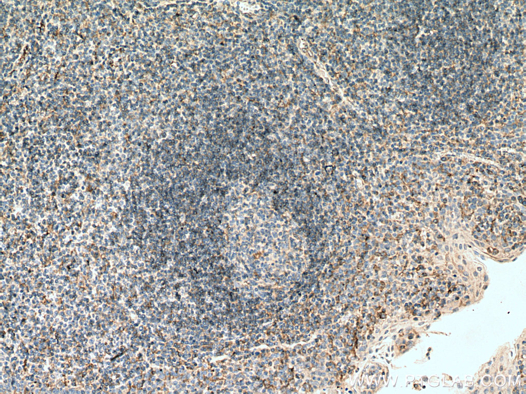 IHC staining of human tonsillitis using 67220-1-Ig