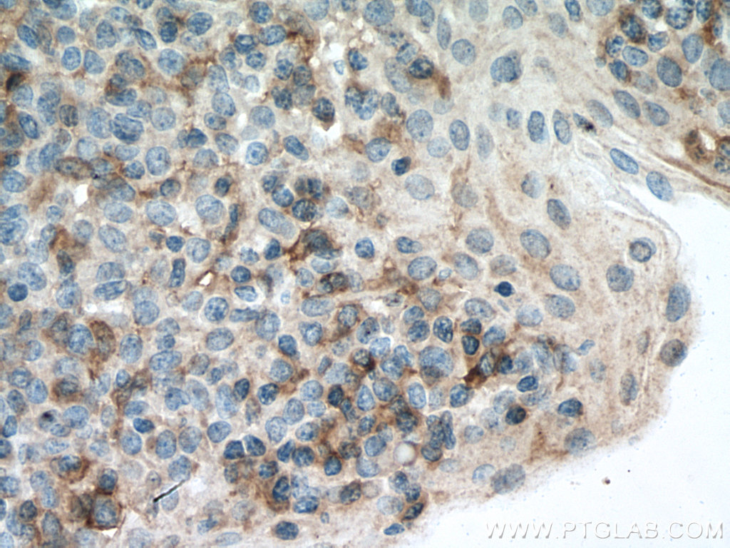 IHC staining of human tonsillitis using 67220-1-Ig