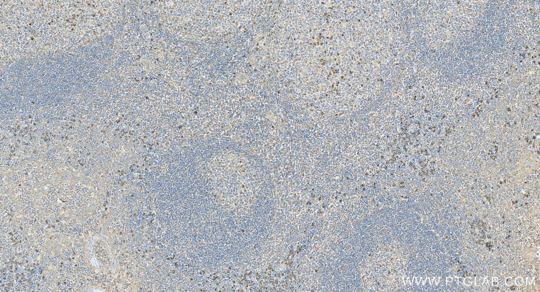 IHC staining of human tonsillitis using 84677-4-RR
