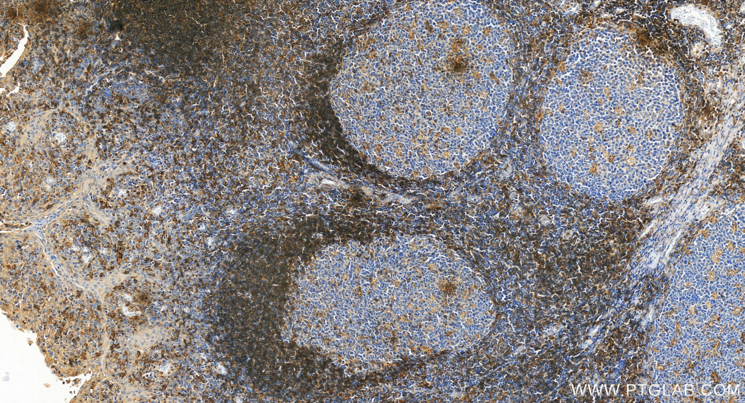 IHC staining of human tonsillitis using 84677-4-RR