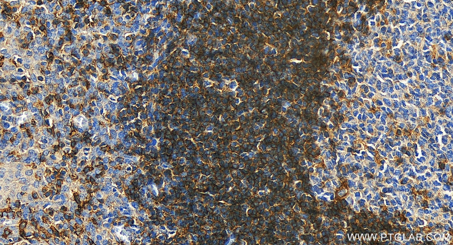 IHC staining of human tonsillitis using 84677-4-RR