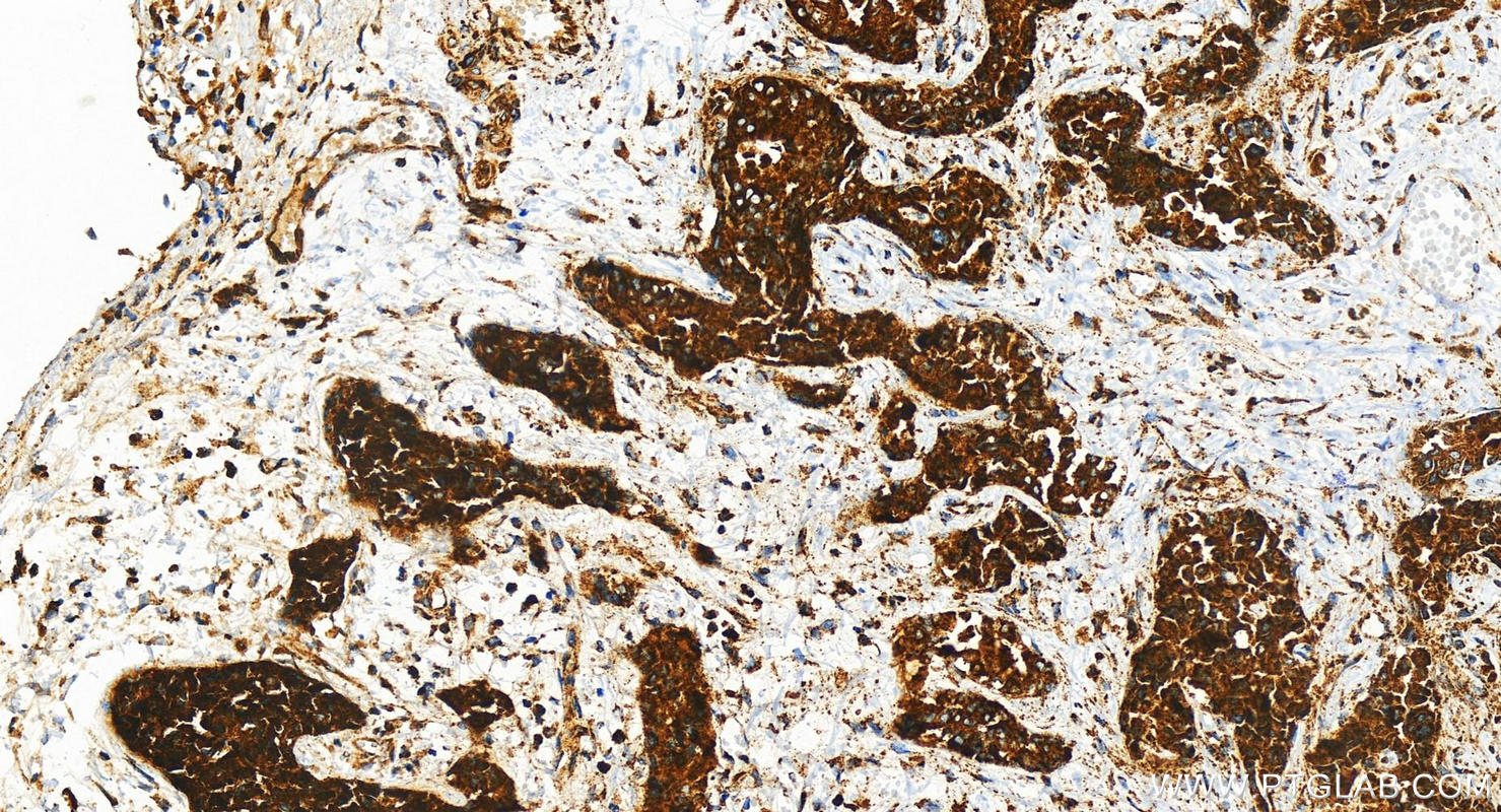 IHC staining of human intrahepatic cholangiocarcinoma using 83210-2-RR