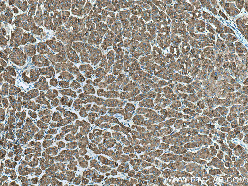 IHC staining of human liver cancer using 66301-1-Ig (same clone as 66301-1-PBS)