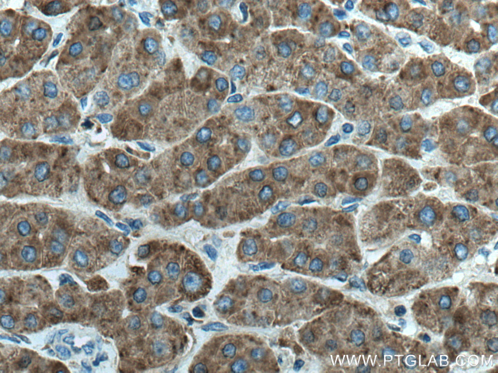 IHC staining of human liver cancer using 66301-1-Ig (same clone as 66301-1-PBS)