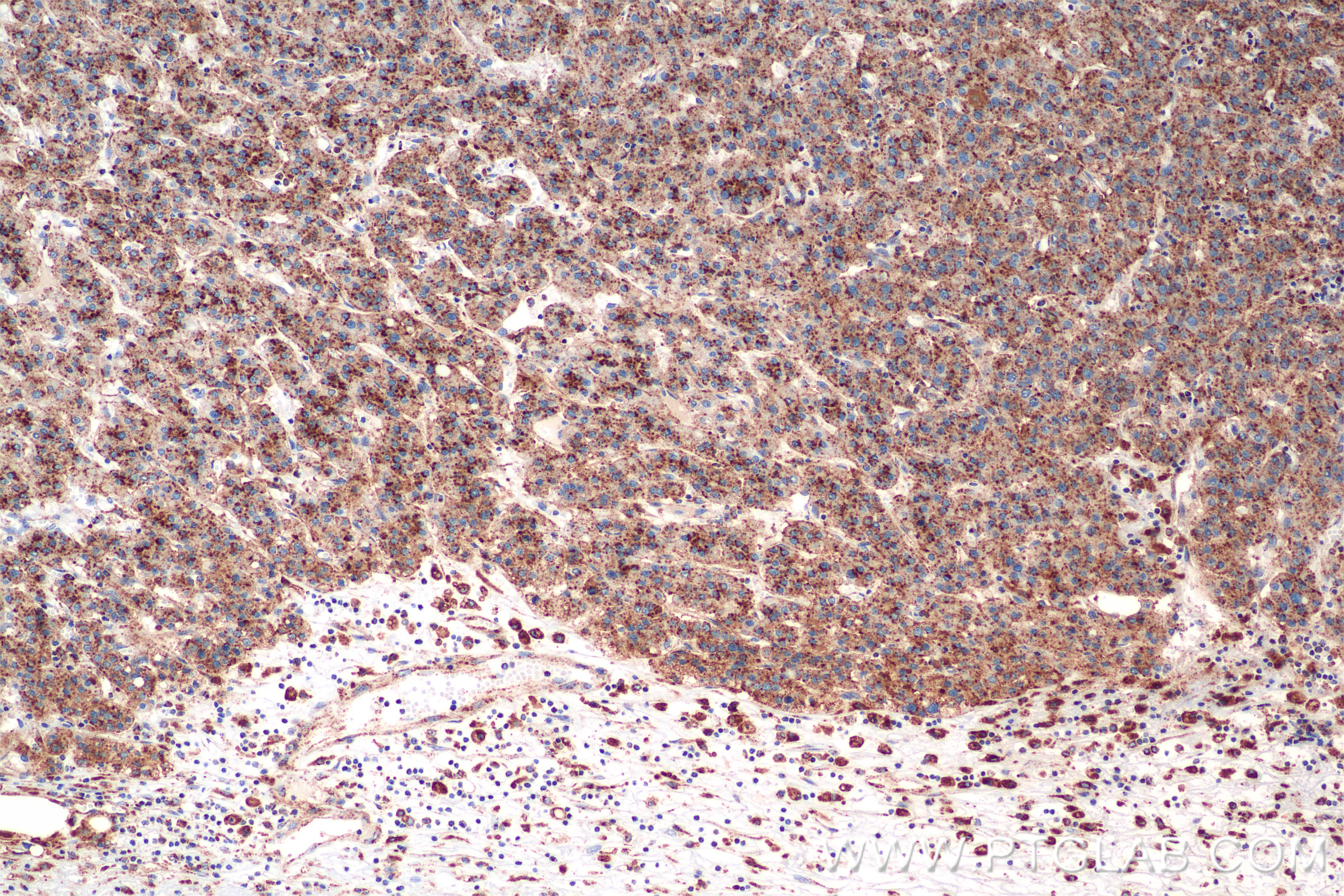 IHC staining of human hepatocellular cancer using 86269-3-RR