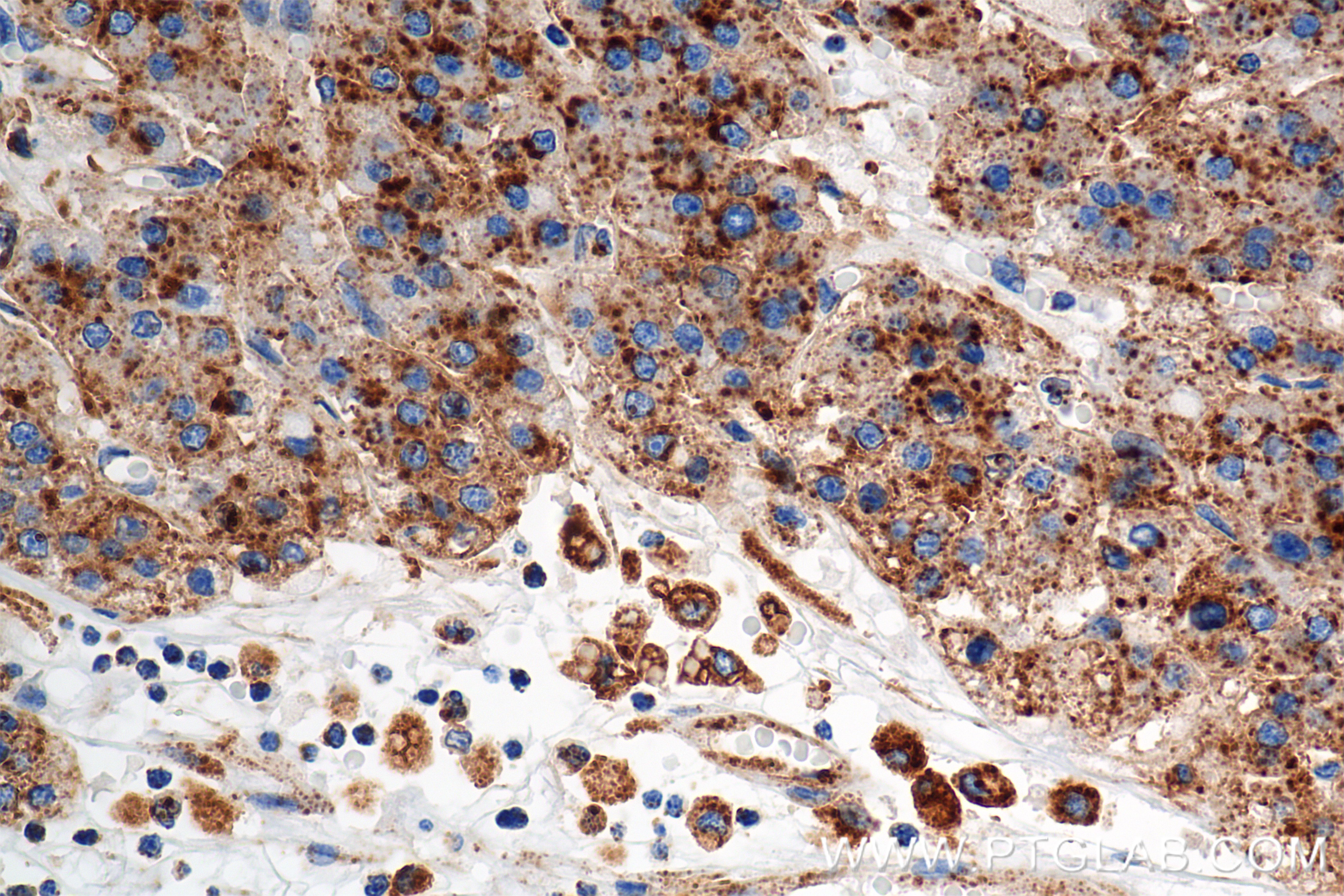 IHC staining of human hepatocellular cancer using 86269-3-RR