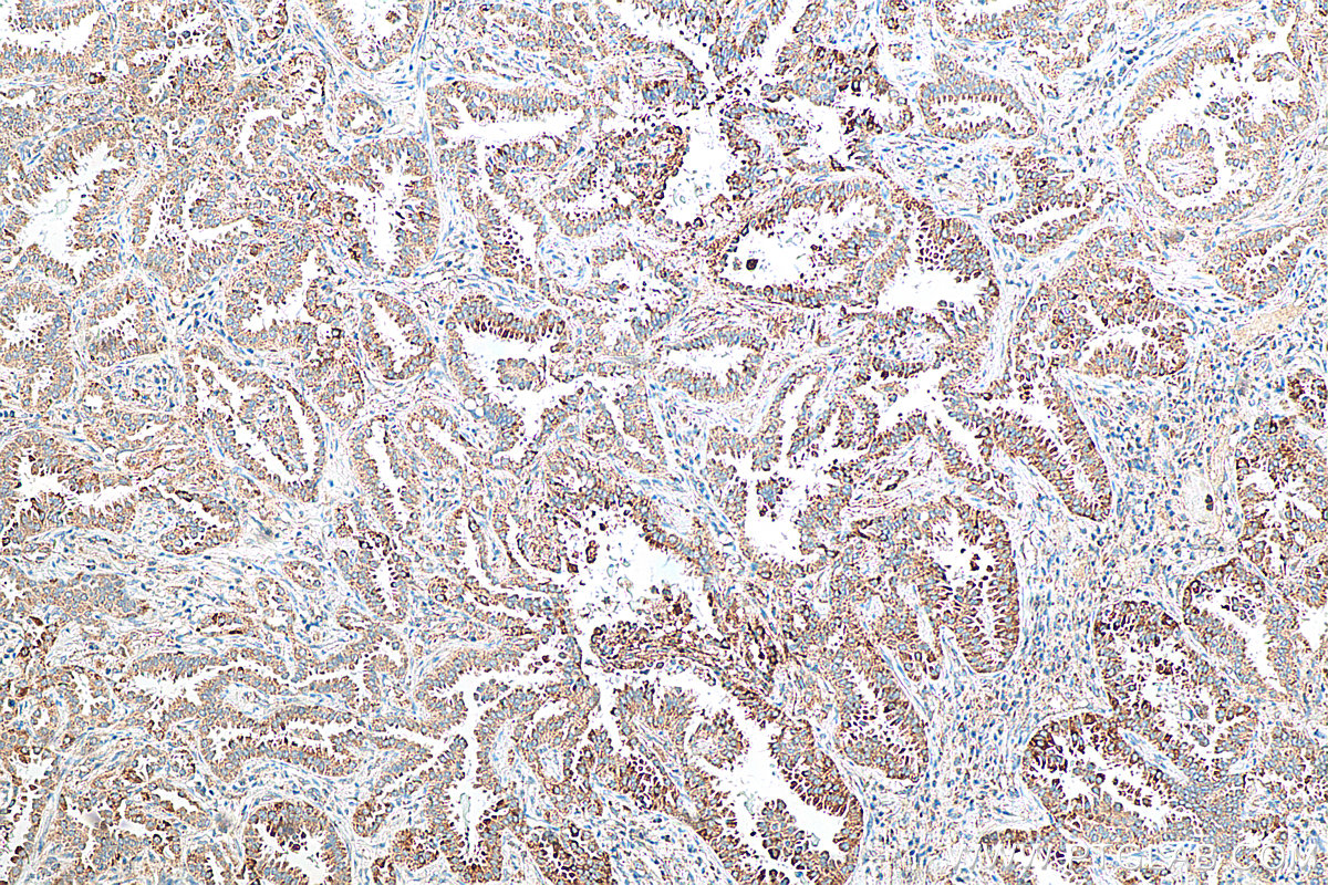 IHC staining of human lung cancer using 10668-1-AP