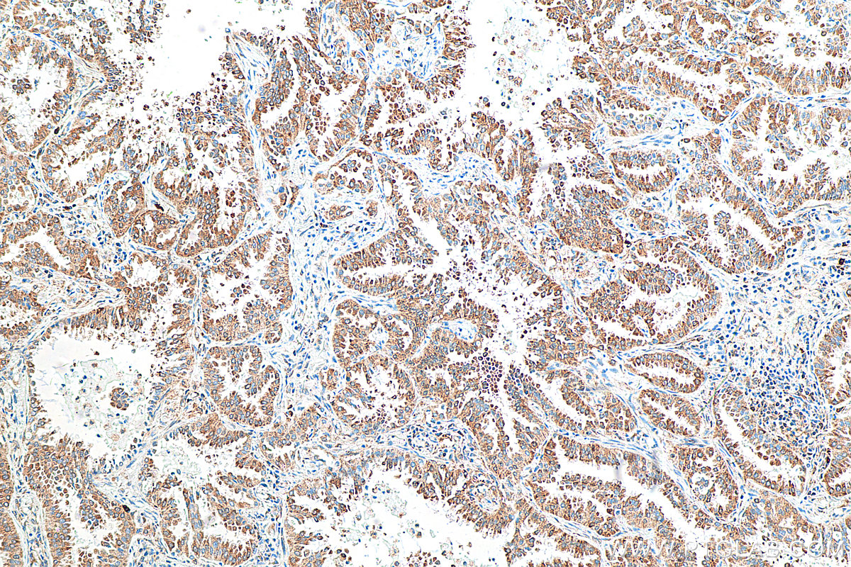 IHC staining of human lung cancer using 67324-1-Ig (same clone as 67324-1-PBS)