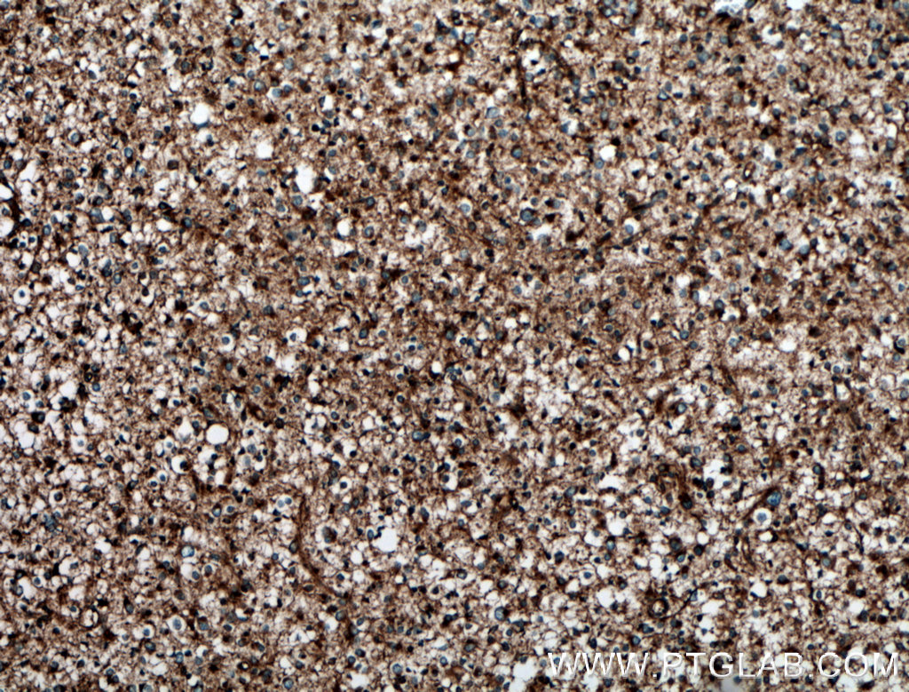 IHC staining of human gliomas using 14612-1-AP