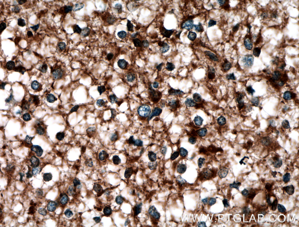 IHC staining of human gliomas using 14612-1-AP