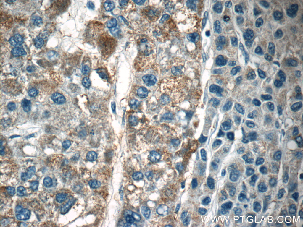 IHC staining of human liver cancer using 18895-1-AP