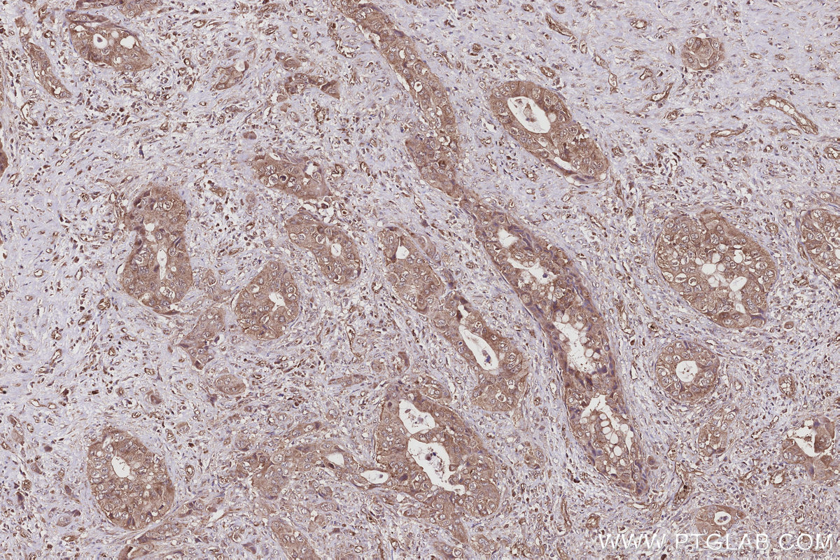 IHC staining of human pancreas cancer using 22441-1-AP IHC staining of human pancreas cancer using 22441-1-AP