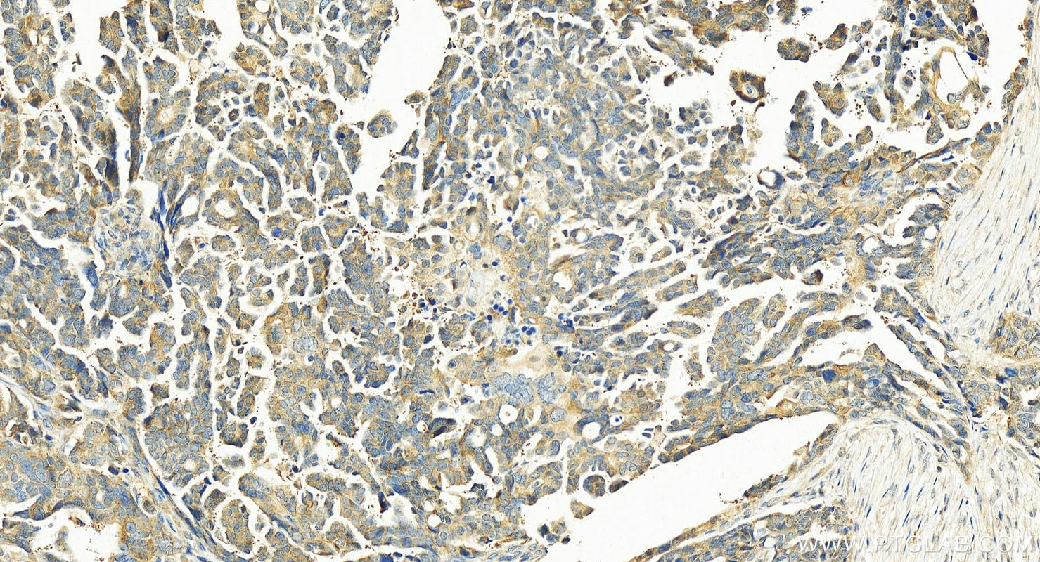 IHC staining of human ovary cancer using 13708-1-AP