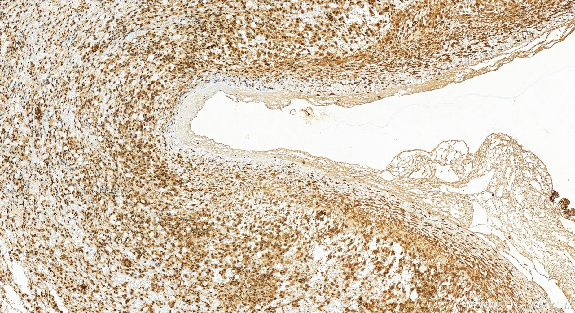 IHC staining of human ovary cancer using 16010-1-AP
