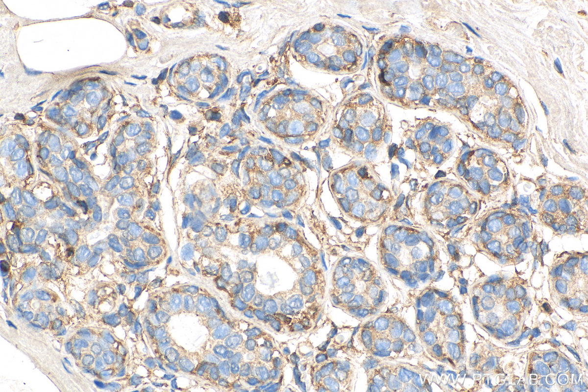 IHC staining of human breast cancer using 68080-1-Ig