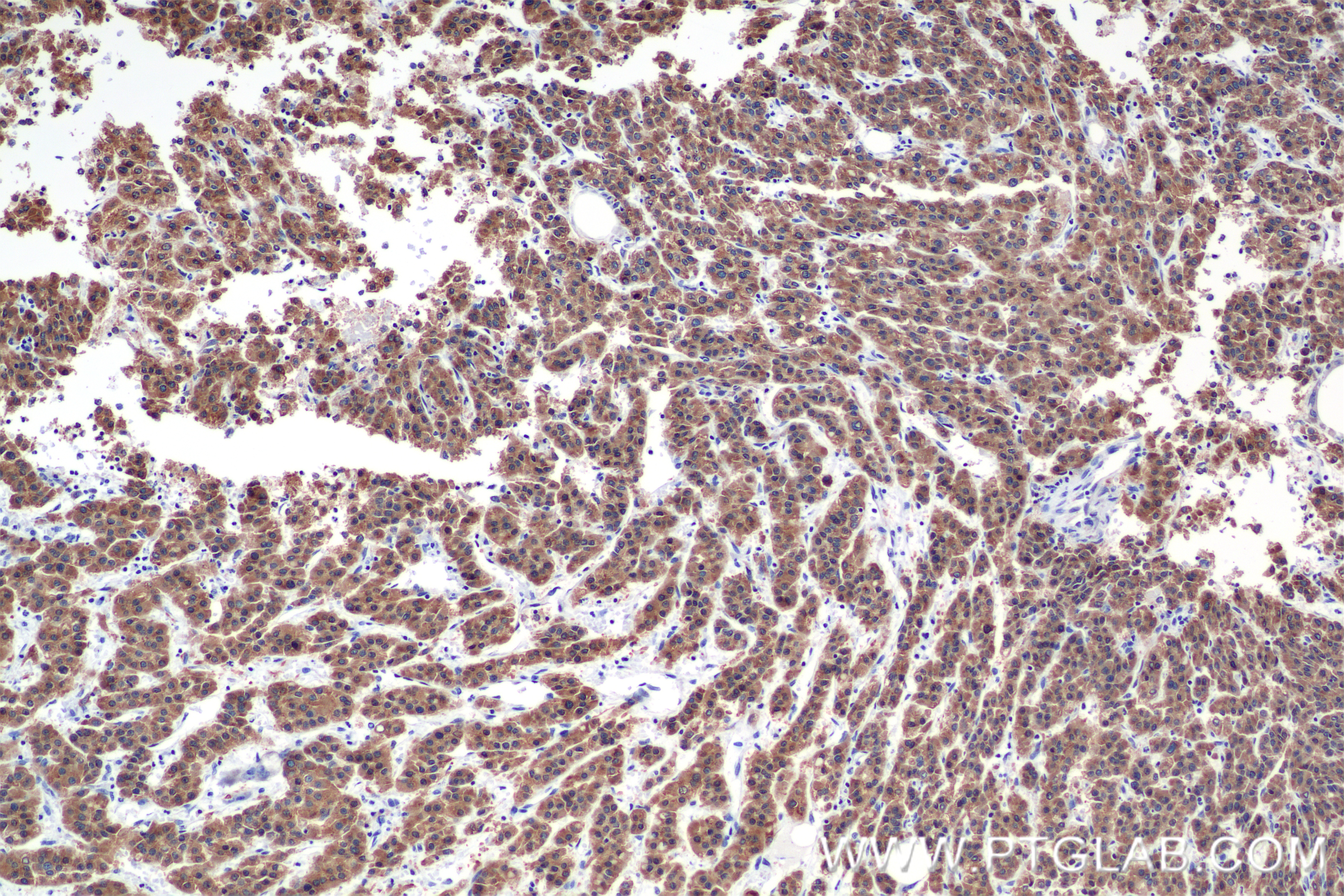 IHC staining of Human Hepatocellular cancer using 84514-4-RR
