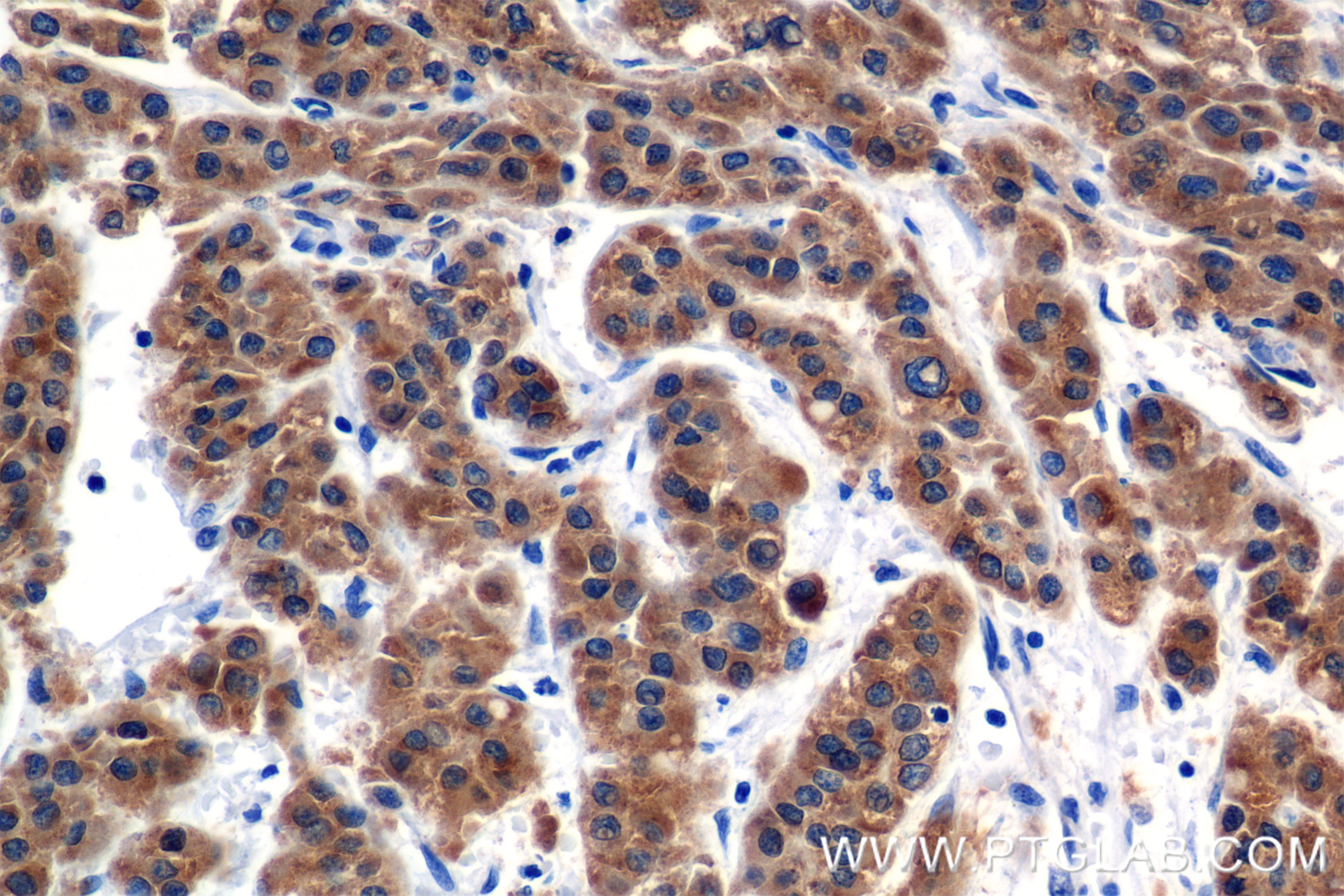 IHC staining of Human Hepatocellular cancer using 84514-4-RR