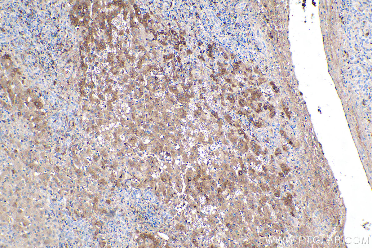 IHC staining of human liver cancer using 66181-1-Ig (same clone as 66181-1-PBS)