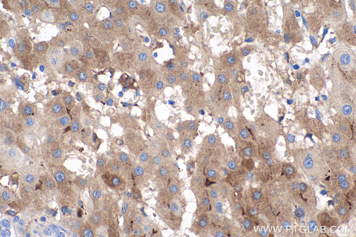 IHC staining of human liver cancer using 66181-1-Ig (same clone as 66181-1-PBS)