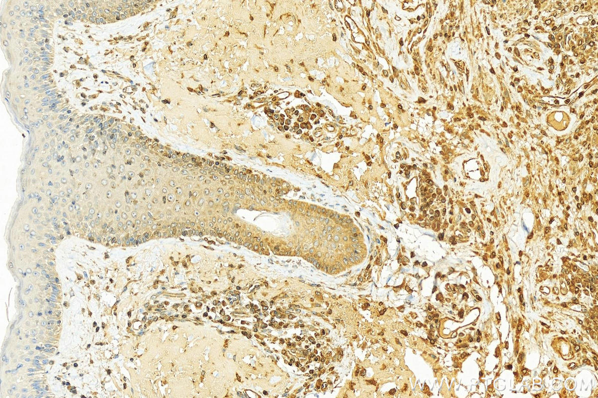 IHC staining of human skin cancer using 12398-1-AP