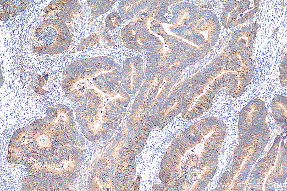 IHC staining of human colon cancer using 81004-1-RR (same clone as 81004-1-PBS)