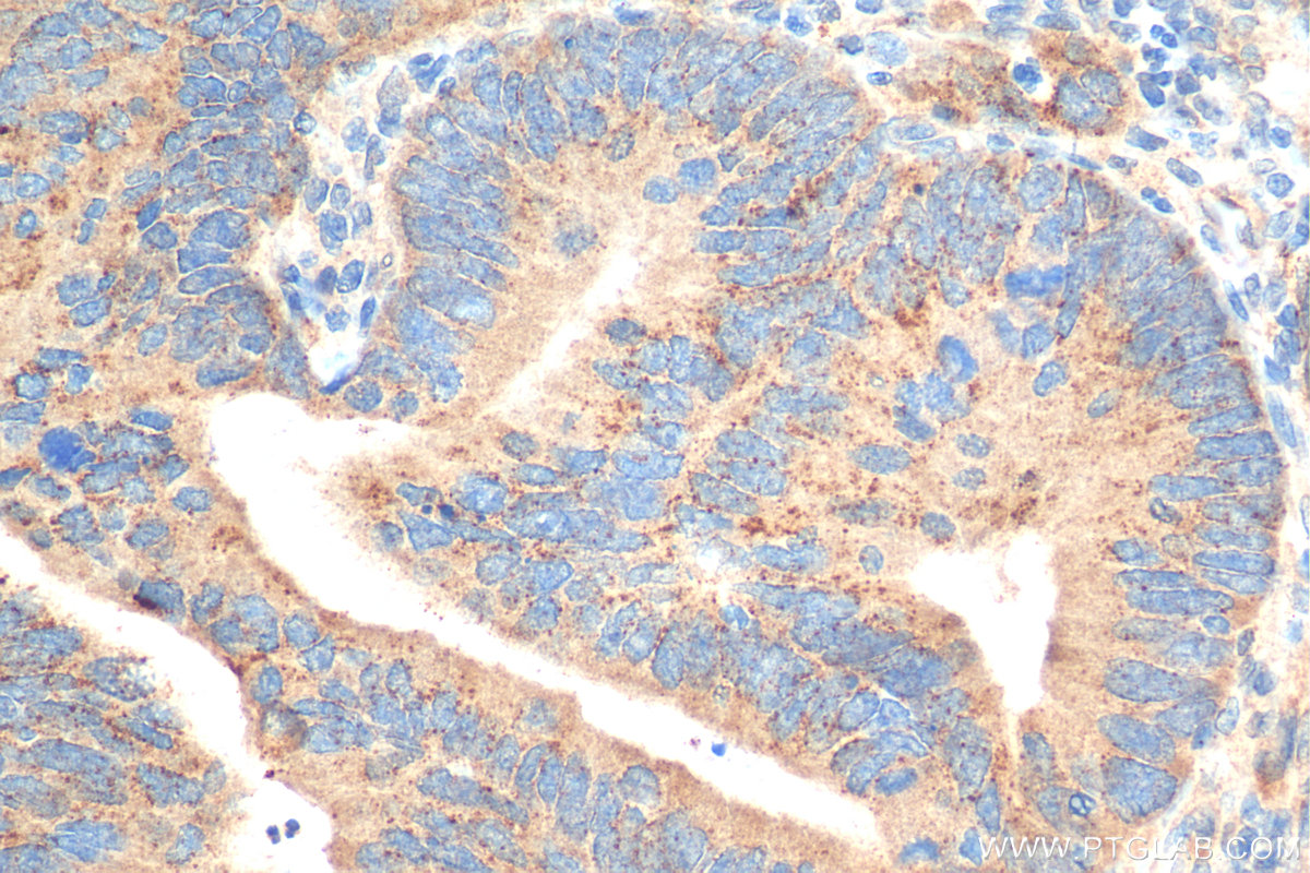IHC staining of human colon cancer using 81004-1-RR (same clone as 81004-1-PBS)
