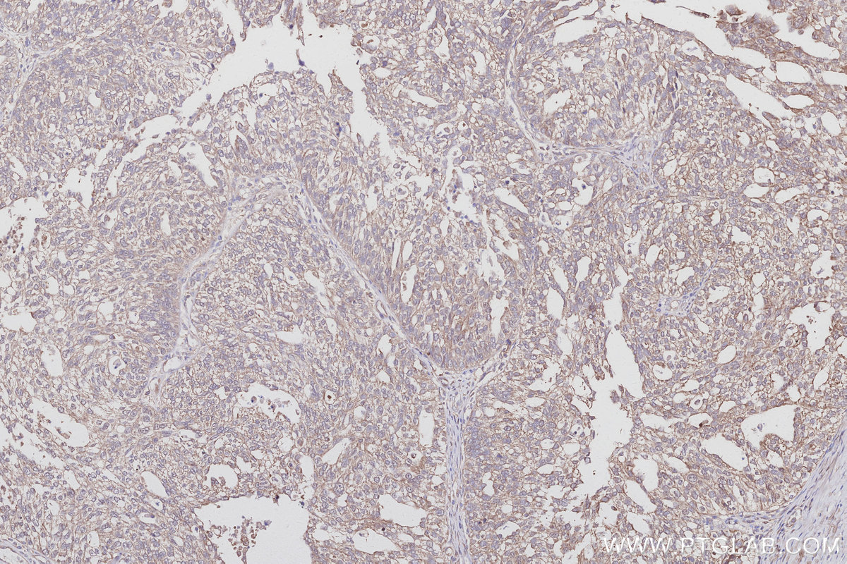 IHC staining of human ovary cancer using 30222-1-AP