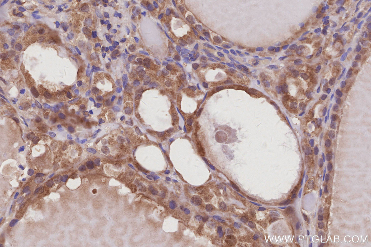 IHC staining of human thyroid cancer using 30222-1-AP