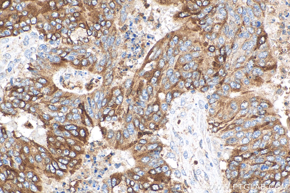 IHC staining of human colon cancer using 26991-1-AP