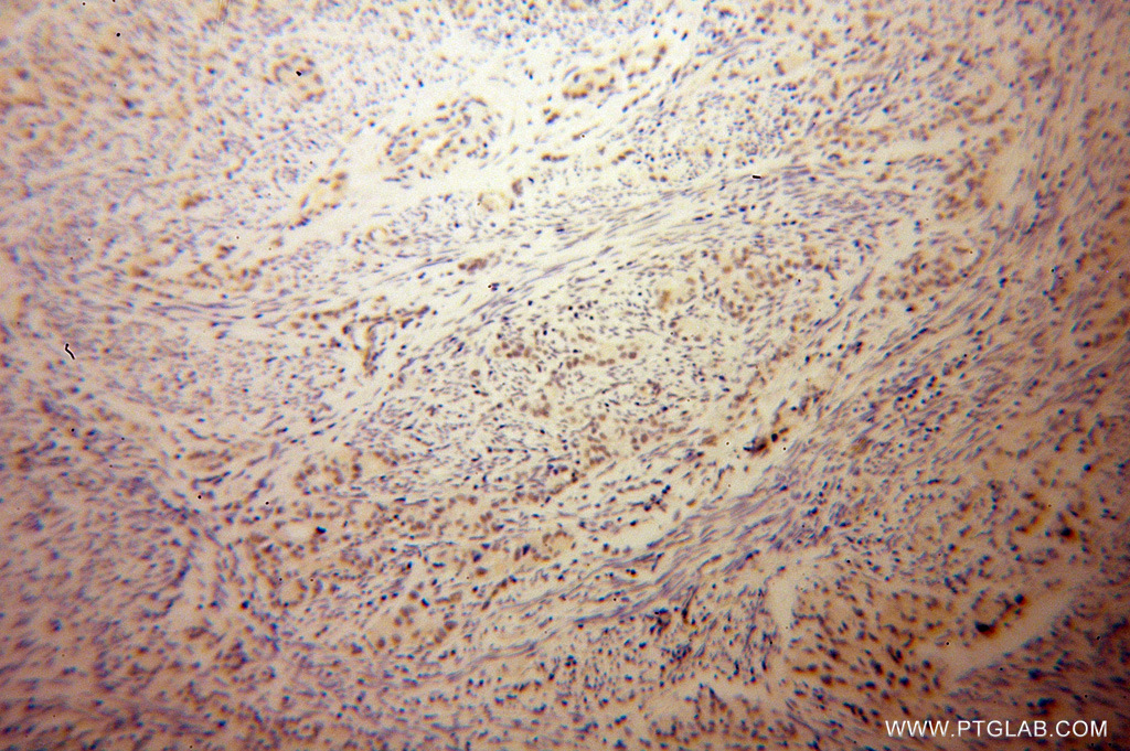 IHC staining of human endometrial cancer using 14476-1-AP