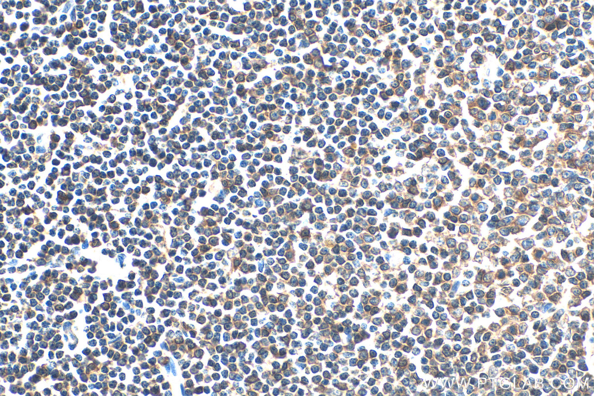 IHC staining of human lymphoma using 13025-1-AP