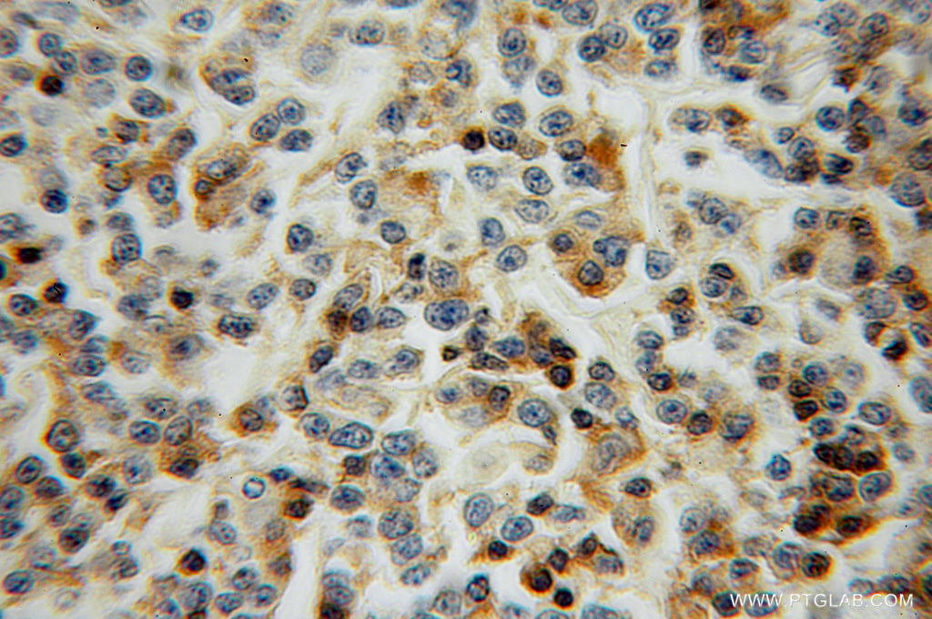 IHC staining of human lymphoma using 13025-1-AP