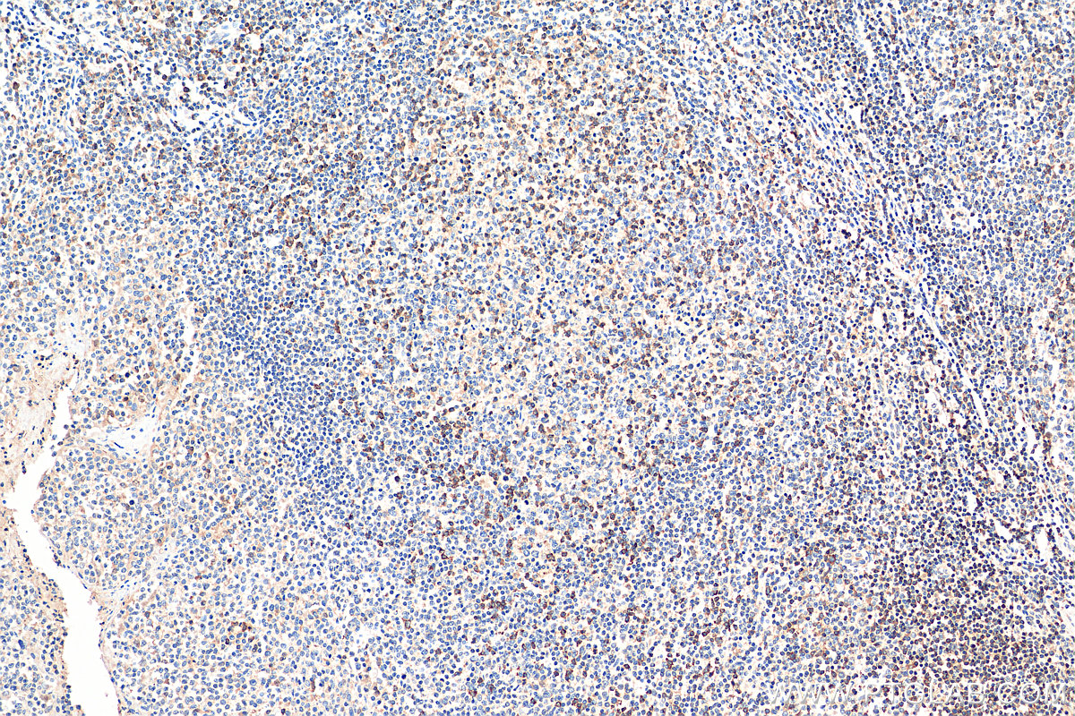 IHC staining of human tonsillitis using 12728-1-AP