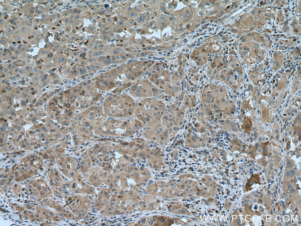 IHC staining of human liver cancer using 13213-1-AP