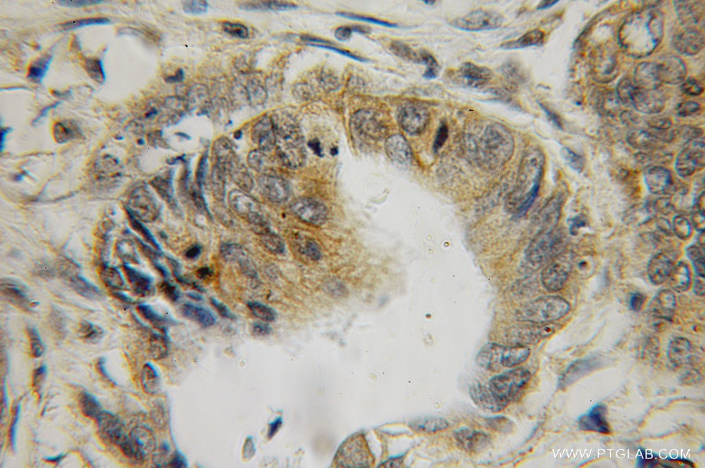 IHC staining of human colon cancer using 12849-2-AP