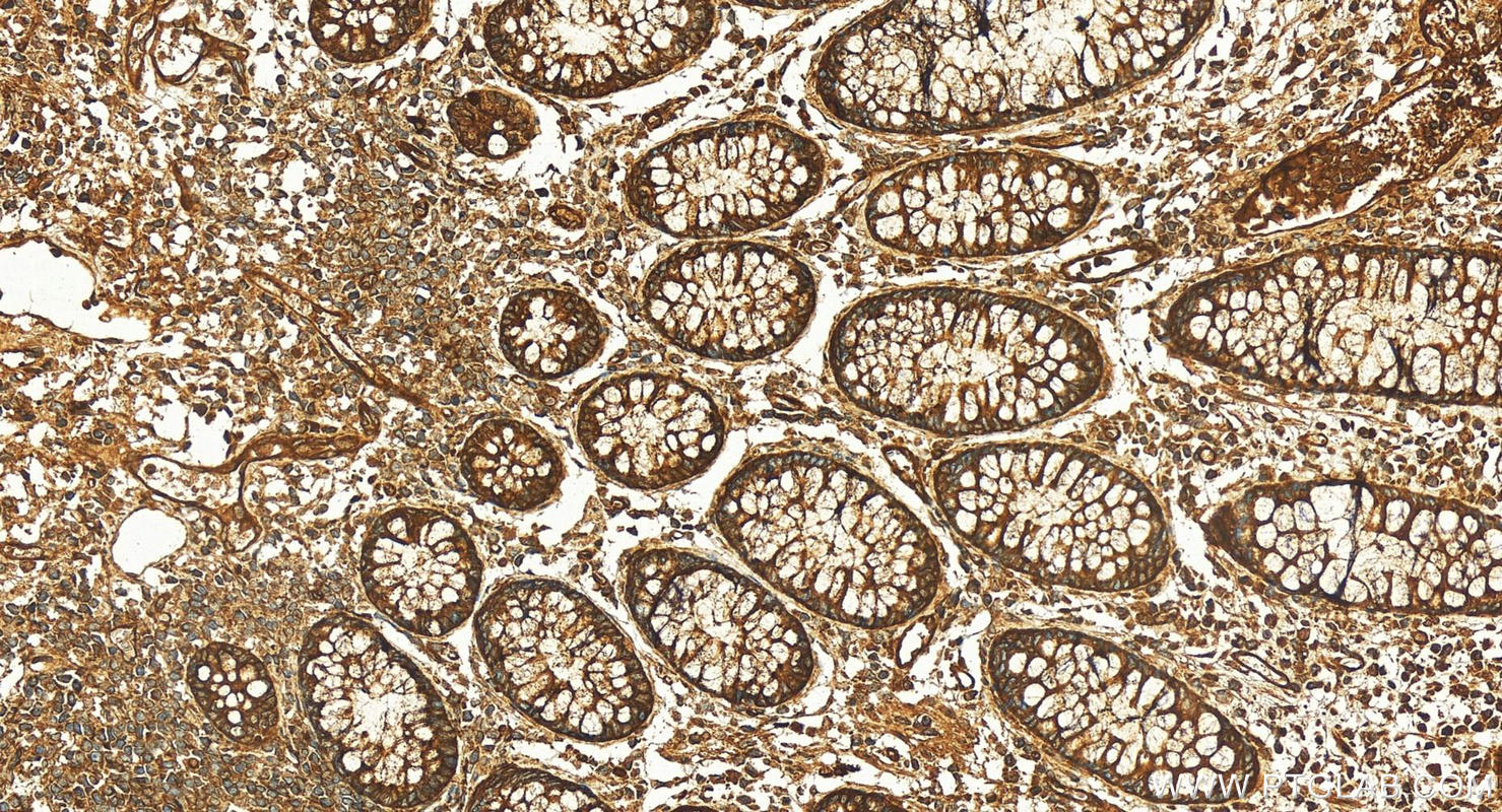 IHC staining of human colon cancer using 10281-1-AP