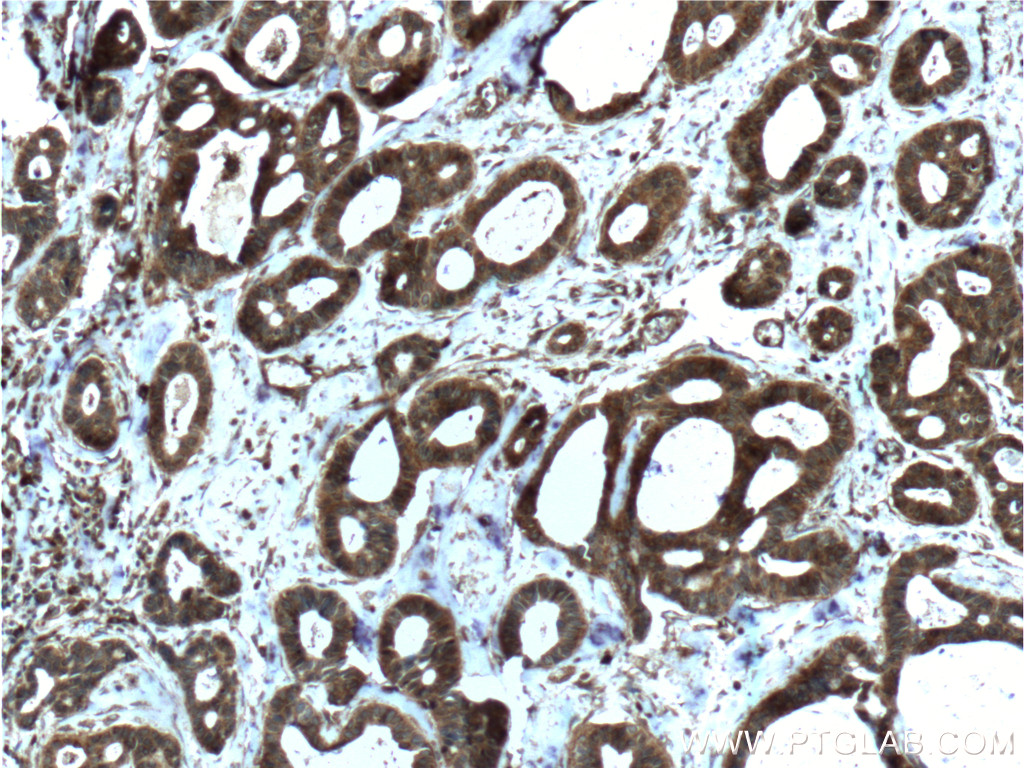 IHC staining of human breast cancer using 60066-1-Ig (same clone as 60066-1-PBS)