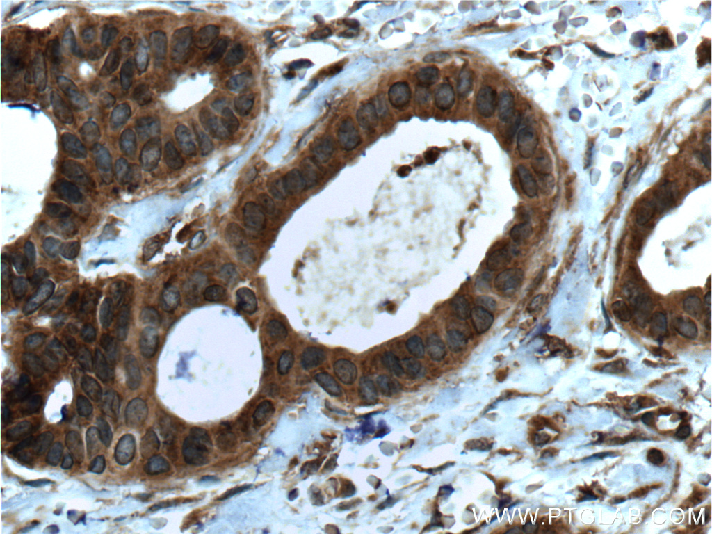 IHC staining of human breast cancer using 60066-1-Ig (same clone as 60066-1-PBS)