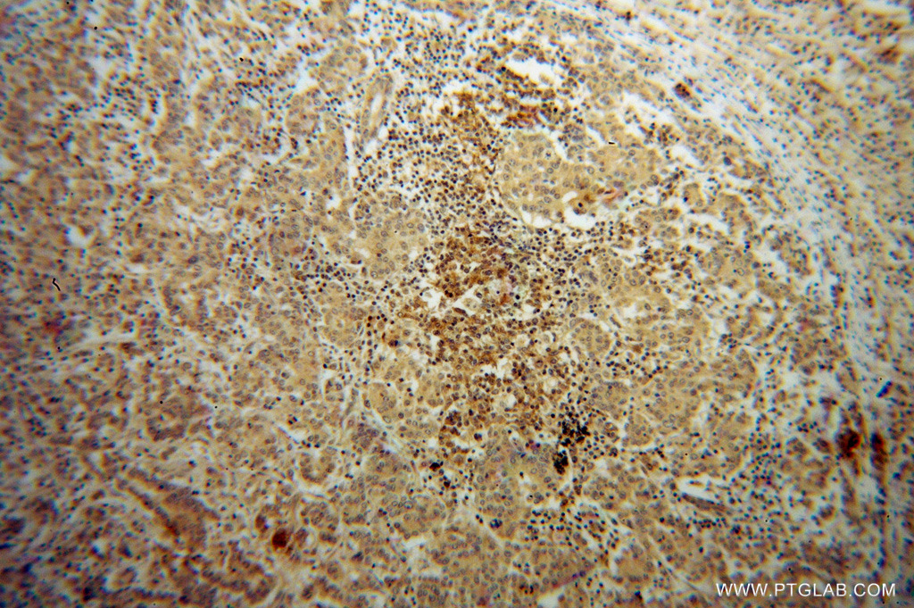 IHC staining of human breast cancer using 13391-1-AP (same clone as 13391-1-PBS)