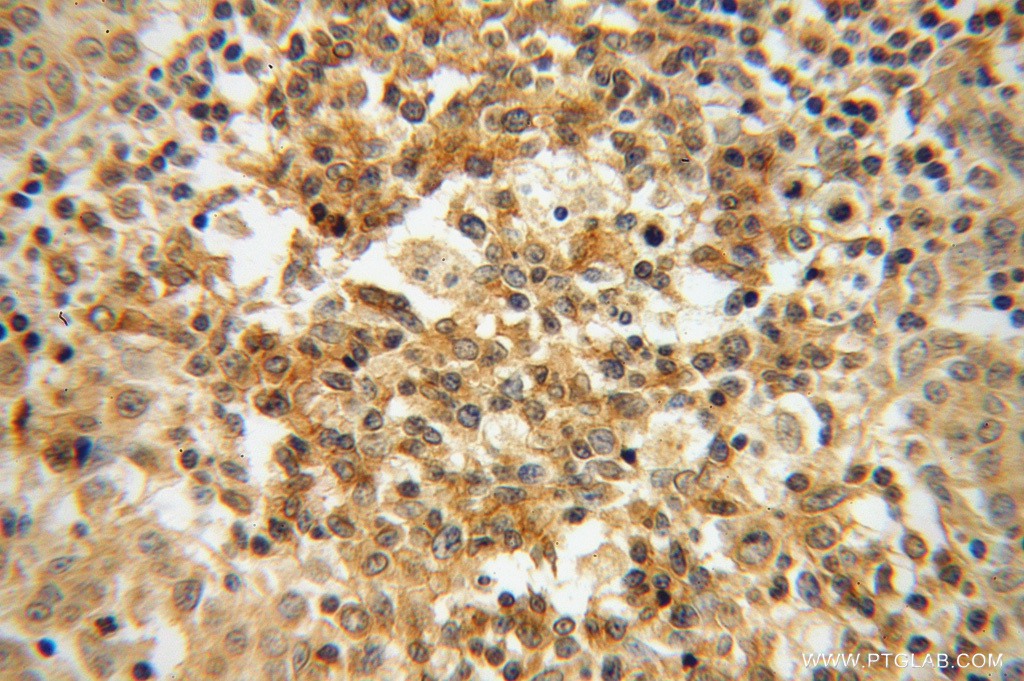 IHC staining of human breast cancer using 13391-1-AP (same clone as 13391-1-PBS)