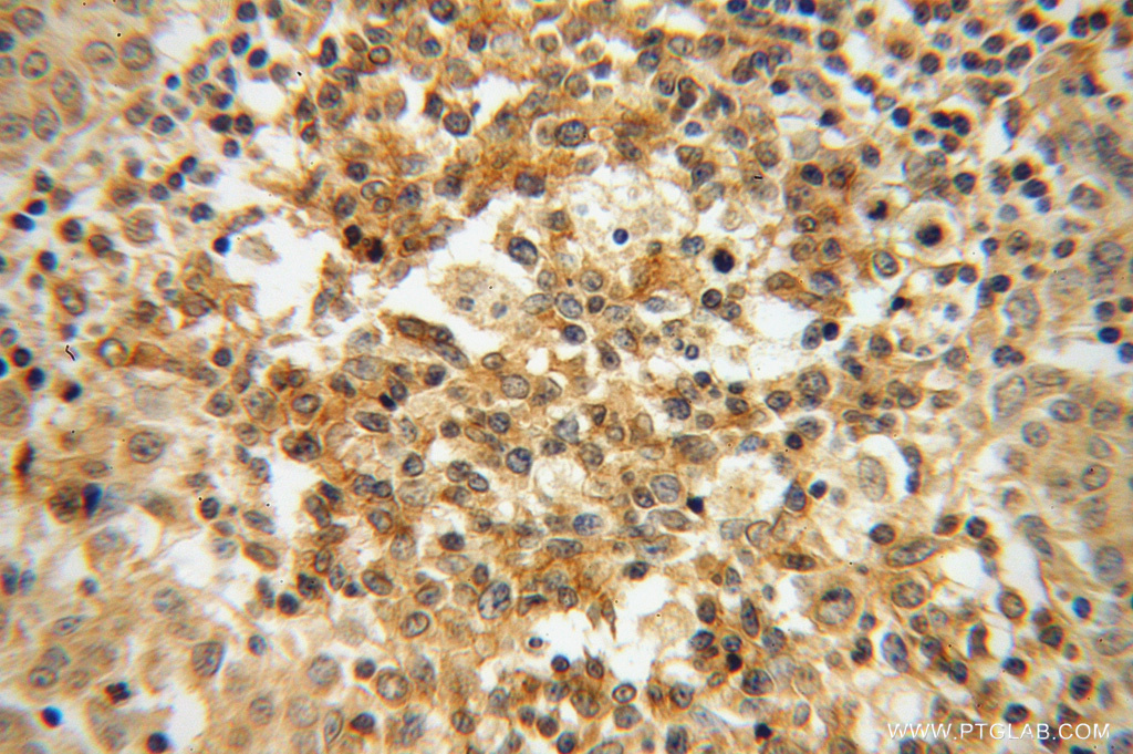 IHC staining of human breast cancer using 13391-1-AP