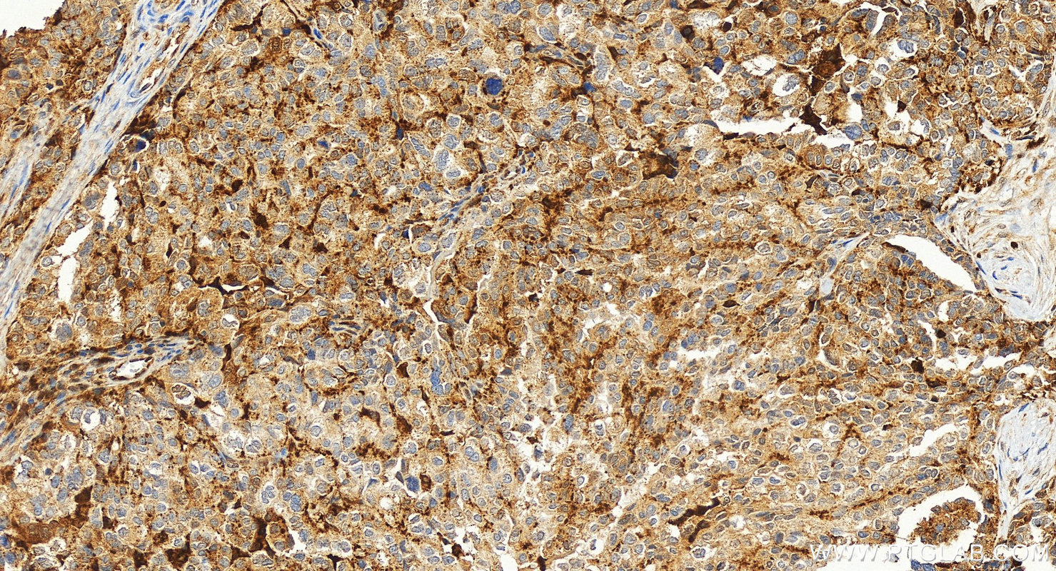 IHC staining of human ovary cancer using 30409-1-AP IHC staining of human ovary cancer using 30409-1-AP