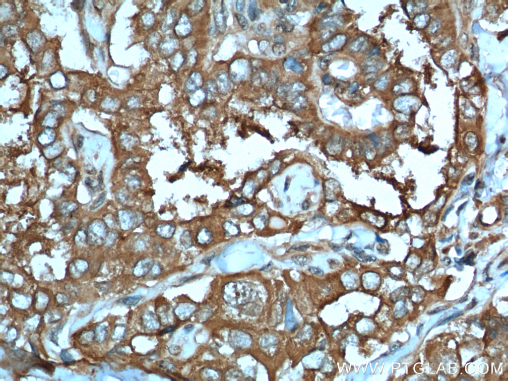 IHC staining of human thyroid cancer using 26424-1-AP