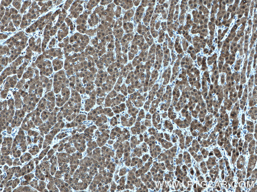 IHC staining of human liver cancer using 15759-1-AP