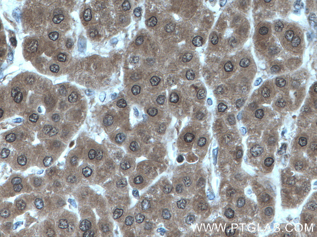 IHC staining of human liver cancer using 15759-1-AP