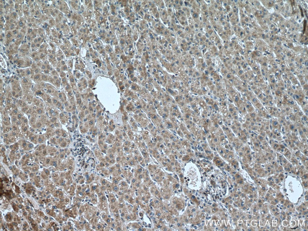 IHC staining of human liver cancer using 11577-1-AP