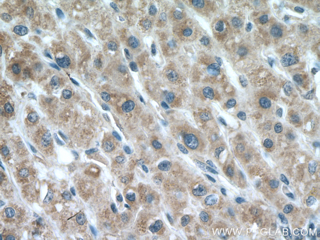 IHC staining of human liver cancer using 11577-1-AP